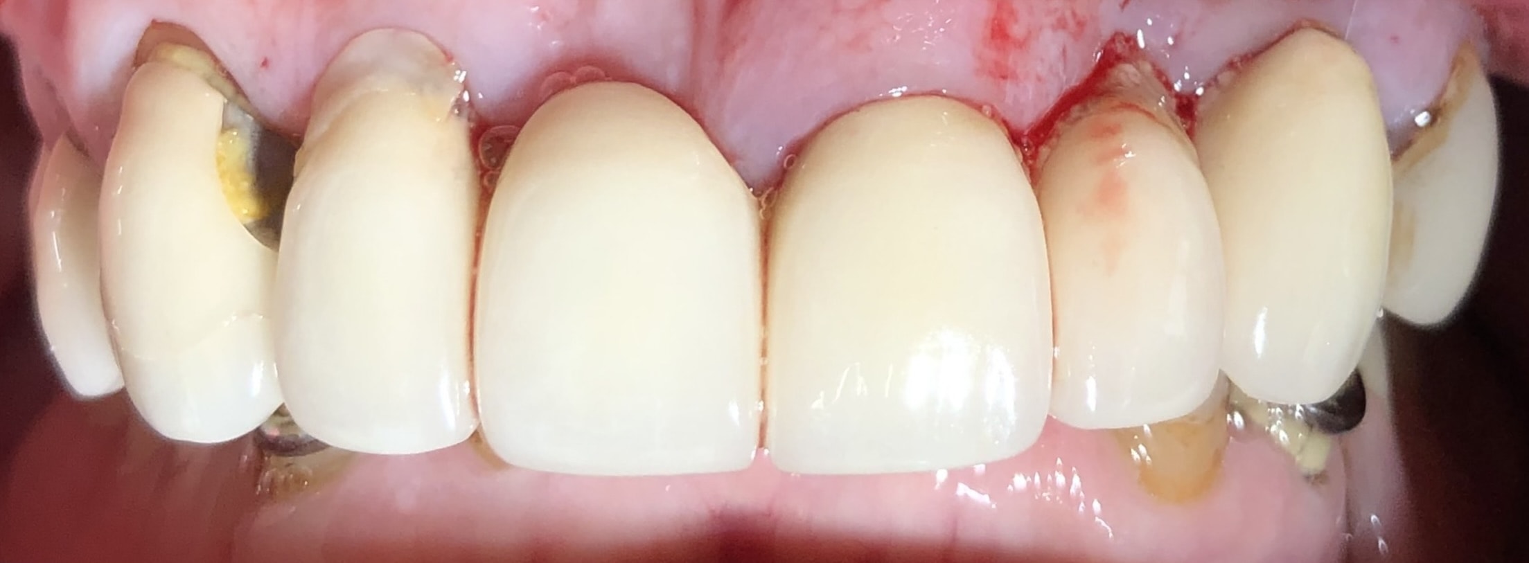 harrogate dental dental bridges before