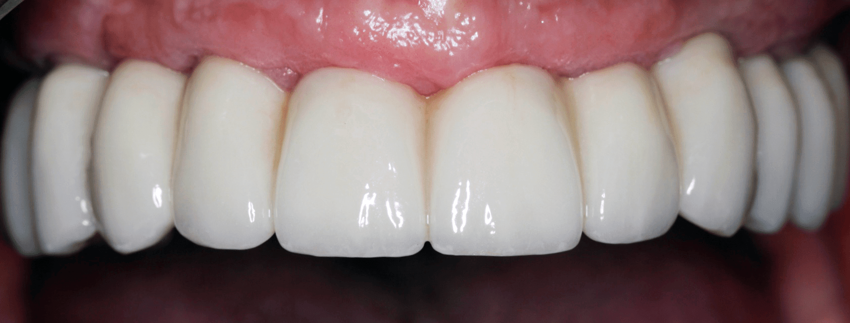 harrogate dental dental bridges after