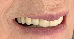 fixed bridge dental implants harrogate
