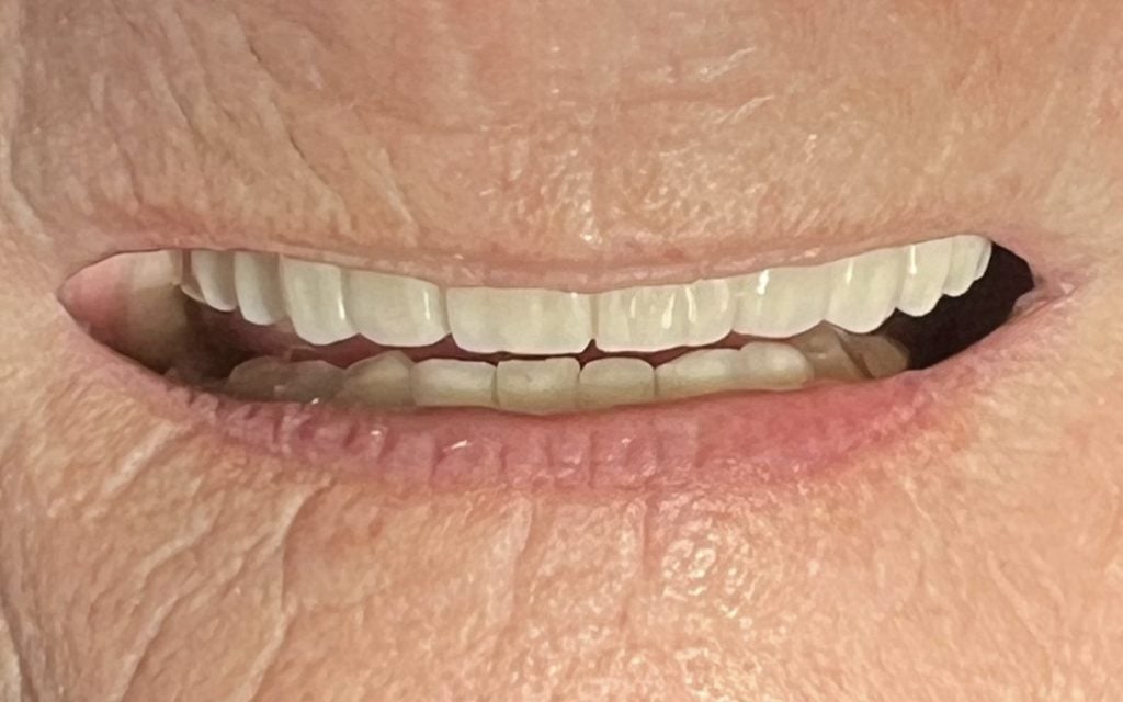 after implant bridge