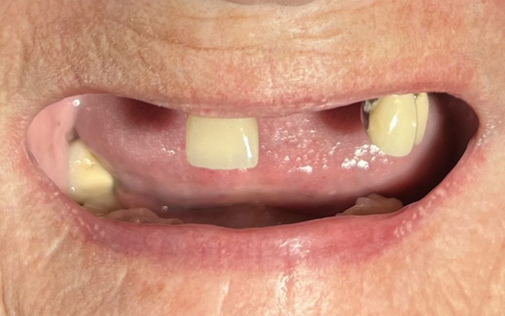 before implant bridge
