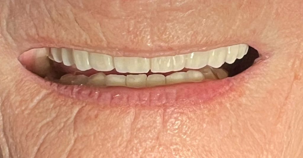 restoring smile with dental implant bridge harrogate dentist